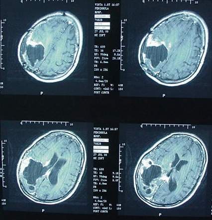 Augmentation de 40% des tumeurs cérébrales au Danemark de 2001 à 2010 - Registre du Cancer Danois - 16/12/2011